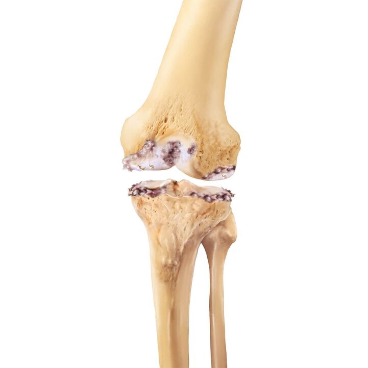Knee joint destruction and arthropathy