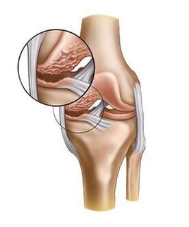 Cartilage damage