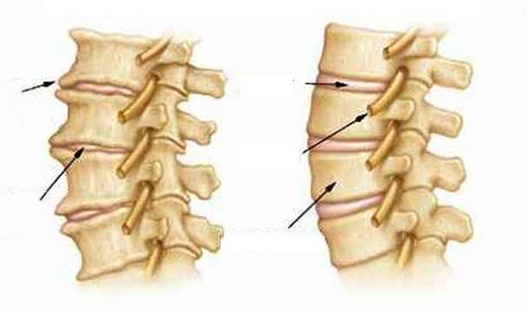 What is osteochondral disease