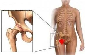 Causes of hip joint development