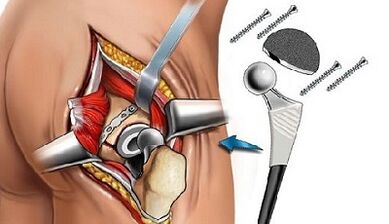 Internal opthetics of hip joints