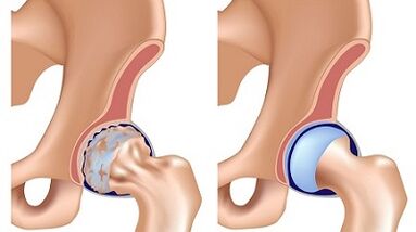 Symptoms of hip arthritis