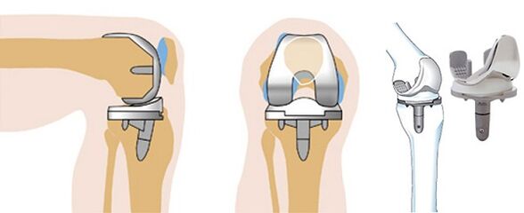 Internal opthetics operation of knee joint