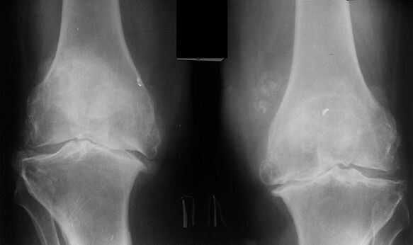 X-rays are a way to diagnose knee joints