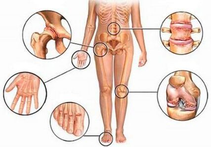 Arthritis and arthritis in various joints