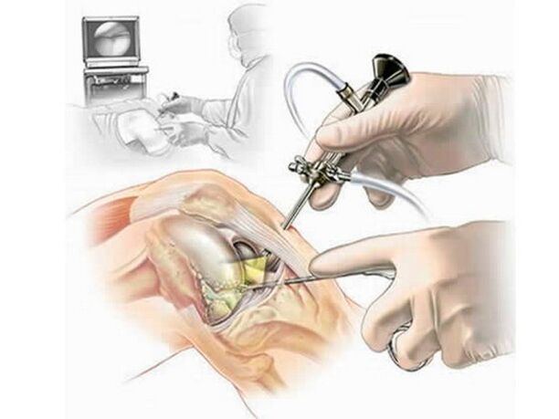 Arthroscopy