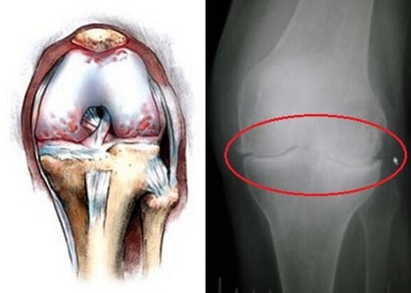 Deformation of joint knee joints