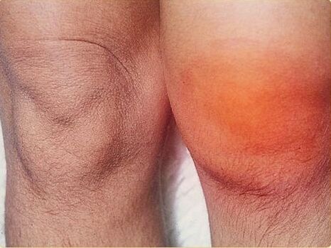 Knee arthritis affected by arthritis