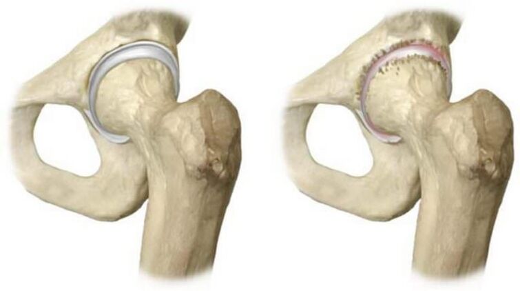 Healthy Hip and Head Necrosis Causes Pain