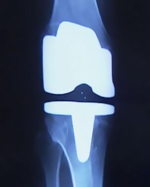 X-ray of knee with artificial prosthesis after joint replacement surgery