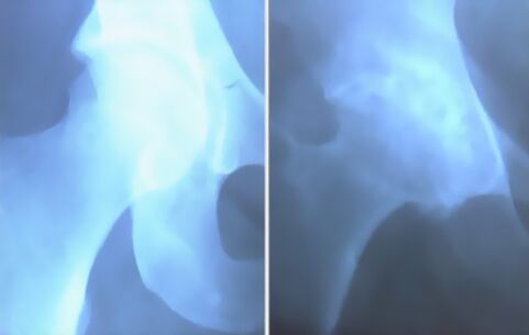 images of knee arthrosis