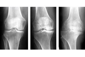 X-ray examination of the various stages of joint arthritis