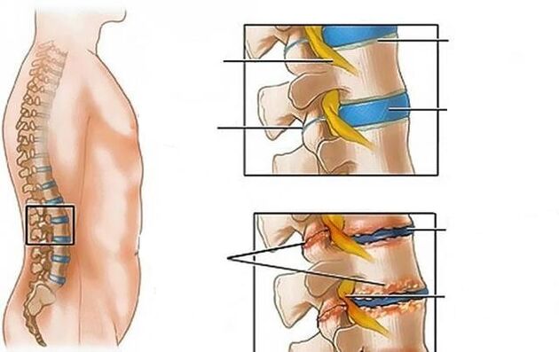 Lumbar osteochondrosis causes back pain