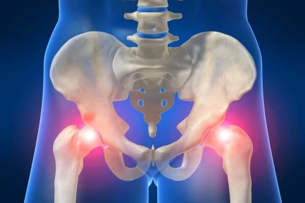 Hip joint disease